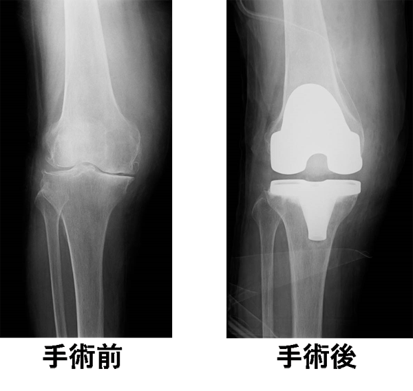 今季ブランド 変形性膝関節症に対する人工膝関節置換術後の理学療法DVD ...